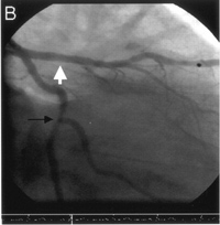 Appropriate angiographic follow-up result at 7 months less-thanigreater-thanAnn Intern Medless-thanslashigreater-than 20051435