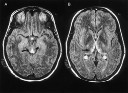 Wernickes encephalopathy is often seen with alcoholism as in this image from ACPs MKSAP Diagnosis in the current case was more difficult because the patient was not an alcoholic MKSAP image copy