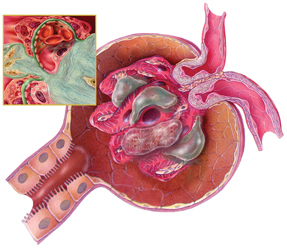 Illustration of a renal glomerulus with diabetic glomerulonephropathy Shown are changes related to diabetic renal disease hyaline degeneration of the arterioles fibrin cap formation among the tuft 
