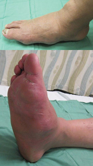 Images of Charcot foot show the striking physical findings of bounding pulse and marked soft tissue edema The foot is hot to touch and erythematous in appearance and there is a bony prominence in th